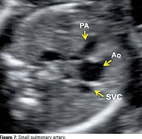 An X Ray Shows The Location Of Pa And Svc Which Are Labeled In Yellow