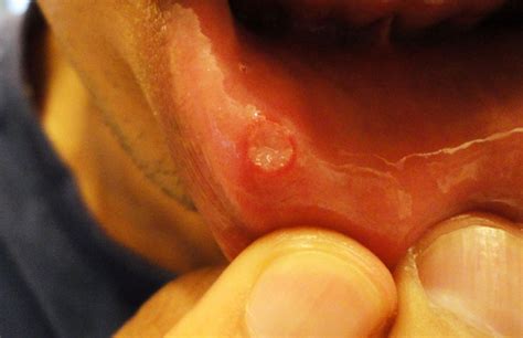 What Is Actually Causing Those Annoying Canker Sores