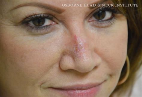 Nose Skin Cancer Surgery Skin Cancer Surgery Treatment