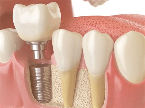 What Are The Essential Things To Know About Bone Grafting In Dental