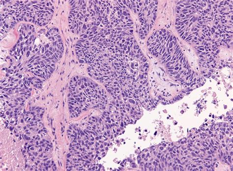 Pathology Outlines High Grade Serous Carcinoma