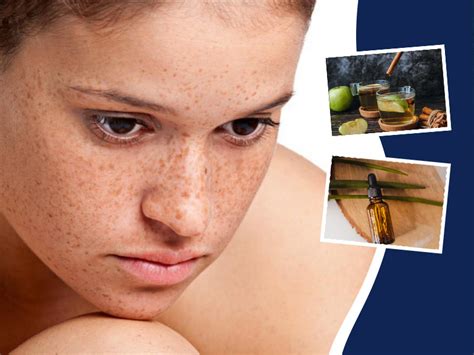 try these 5 home remedies to remove skin tags permanently onlymyhealth