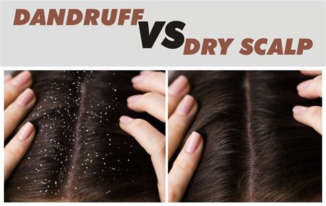 Differences Between Dandruff And Dry Scalp [explained] Medical Darpan