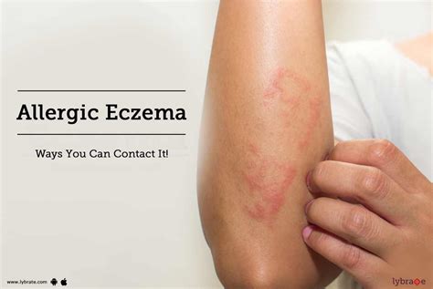 Allergic Eczema Ways You Can Contact It By Dr Jyoti Chourasia
