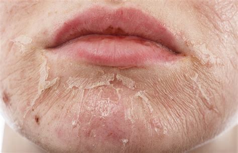 White Spots On Skin Causes And How To Get Rid Of Them