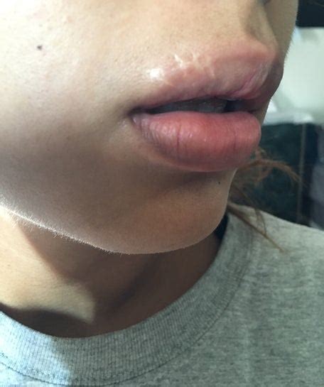 Keloid Scar On Lips Lipstutorial Org