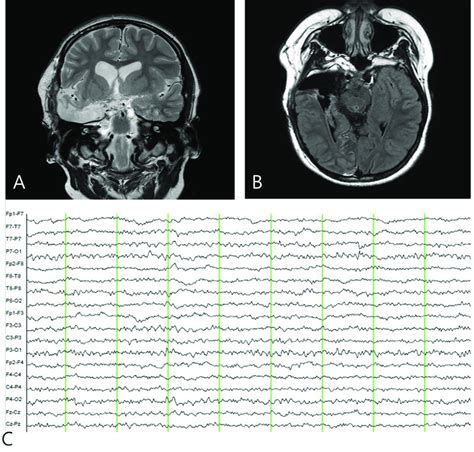 Postoperative Brain Magnetic Resonance Imaging A B And Download Scientific Diagram