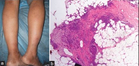 A Study Of The Clinico Histopathological Features Of Erythematous