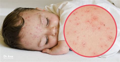 Chicken Pox Symptoms How To Find Natural Relief Dr Axe