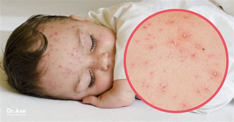 Chicken Pox Symptoms How To Find Natural Relief Dr Axe