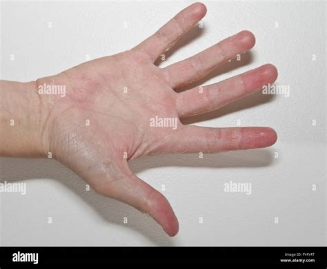 Male Palm With Eczema Isolated On White Background Stock Photo Alamy
