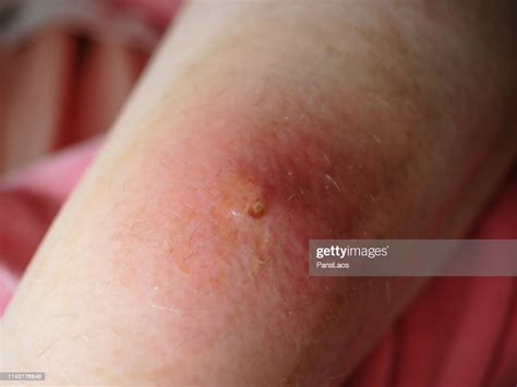 Skin Boil Furuncle Folliculitis On Leg Foto De Stock Getty Images