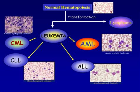 Types Of Leukemia Chart