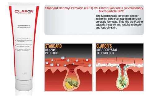 10 Best Benzoyl Peroxide Acne Treatments