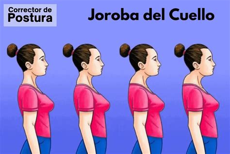 Qué Es La Joroba Del Cuello Fajas Para Corregir La Postura