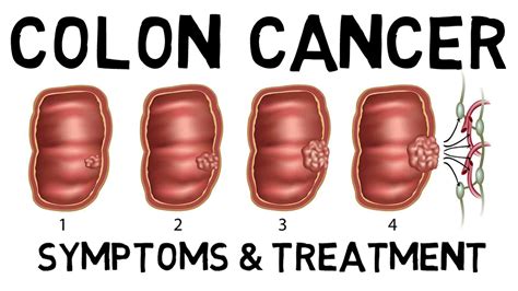 Colon Cancer Symptoms Diagnosis Treatment YouTube