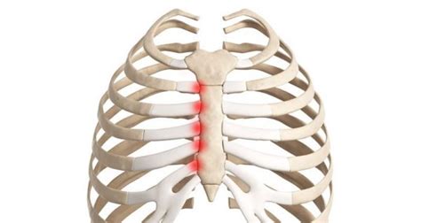 S Ndrome De Tietze Como Tratar Osteopatia E Outras Lombafit