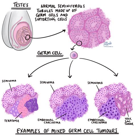 Mixed Germ Cell Tumour Of The Testis MyPathologyReport Ca