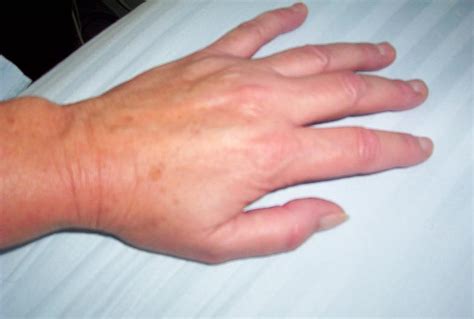 Palindromic Rheumatism Diagnosis And Differential Diagnosis Of