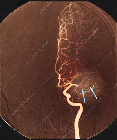 Brain Arteries Before Stroke Treatment Angiogram Stock Image C038