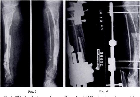 Figure 3 From Congenital Pseudarthrosis Of The Tibia Treatment By