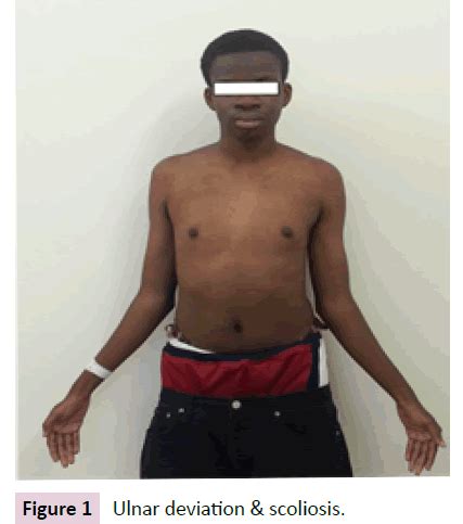 Problematic Sexual Behavior In A Patient Of Xxyy Syndrome A Case