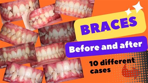 Braces Before And After Time Lapse Smile Transformation Your Dentist Braces Orthodontics