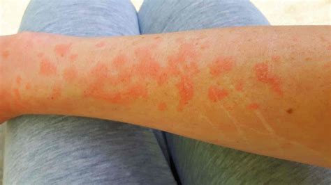 What Does Sun Allergy Rash Look Like See These Pictures