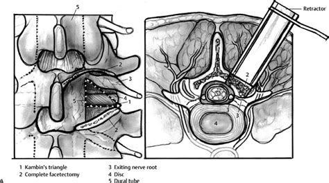 Minimally Invasive Spinal Fusion Procedures Neupsy Key
