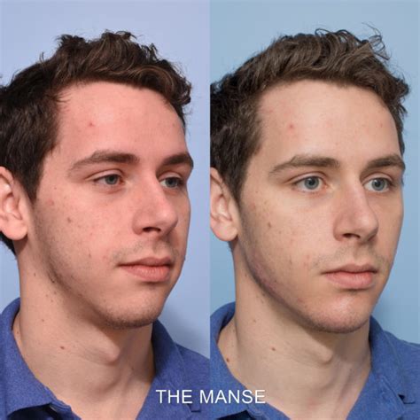 Mens Jawline Filler Before And After