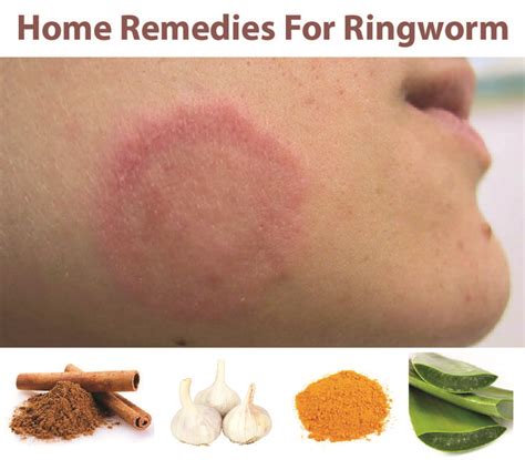 Home Remedies For Ringworm Home Remedies For Ringworm Ringworm