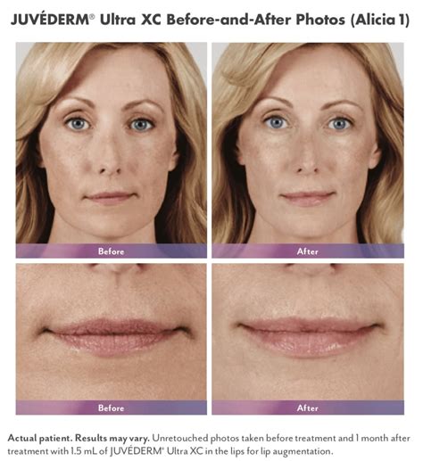 JuvÉderm Ultra Plus Xc Bend Or Cosmetic Fillers Roseburg Albany