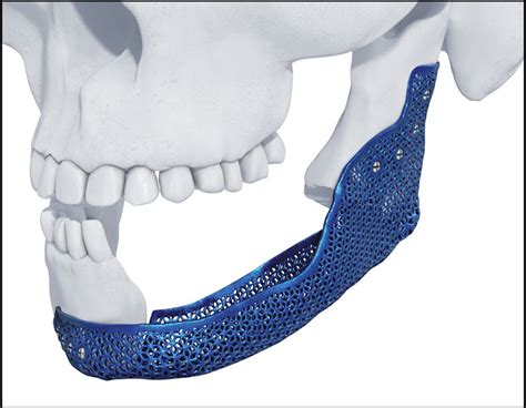3d Printing Medical Devices Depuy Synthes