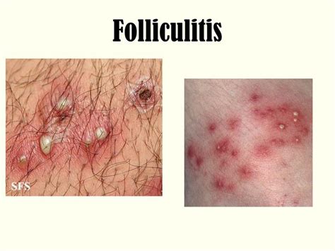 PPT - Skin Wounds Classification PowerPoint Presentation ...