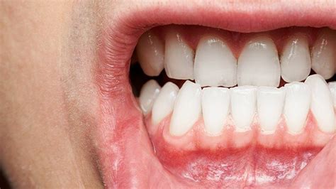What You Need To Know About Gum Disease