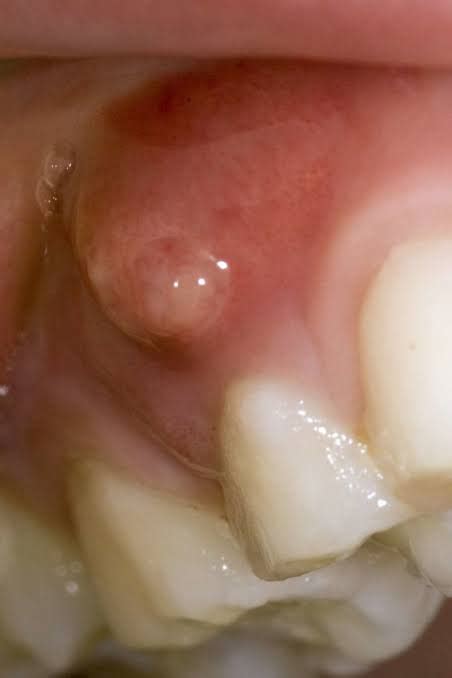 Soft Lump On Gum After Tooth Extraction Is It Dangerous