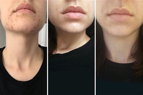 Spironolactone For Acne Before And After Photos