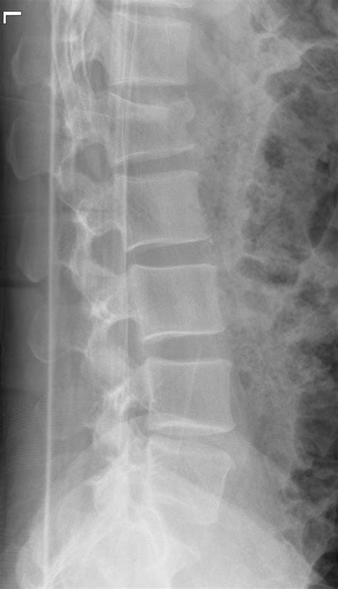 Thoracolumbar Spine X Rays Dont Forget The Bubbles