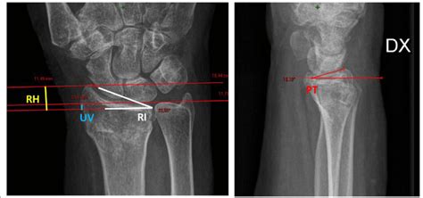 Standard Postero Anterior And Lateral View Radiographs Showing Normal