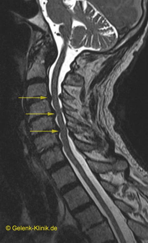 Eine mrt vom rücken in den bereichen hws, bws, lws eignet sich, um bei schmerzen in diesen bereichen diagnosen zu stellen. Wirbelkanalstenose (Spinalstenose): Verengung des ...