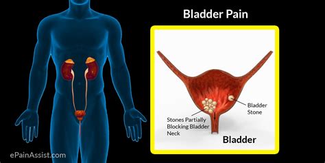 Bladder Pain Pathophysiology Etiology Risk Factors Signs Symptoms