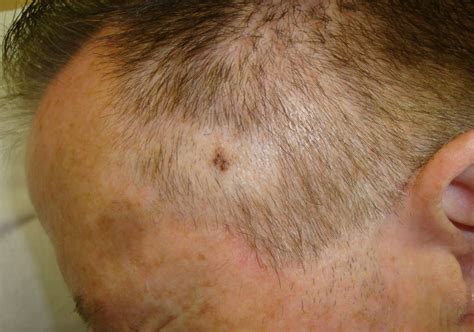 Melanoma On Scalp Pictures Early Stage 1 Scalp Melanoma Images