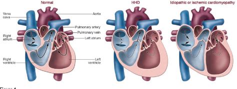 Pdf Ecm Remodeling In Hypertensive Heart Disease Semantic Scholar