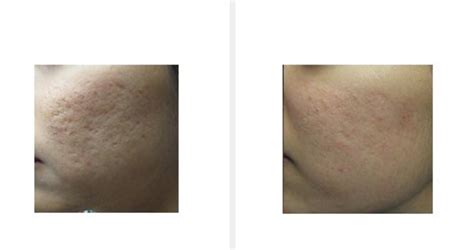 Maybe you would like to learn more about one of these? Pin on ACNE & ACNE SCARS