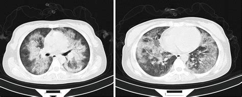 Primary Intravascular Large B Cell Lymphoma Of The Lung A Review And