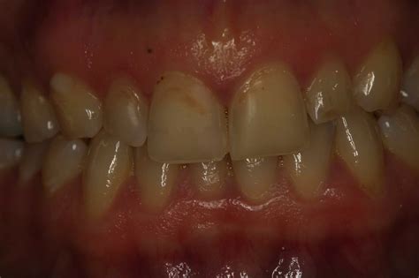 Before Stained Teeth Dr Ari Greenspan Dentist