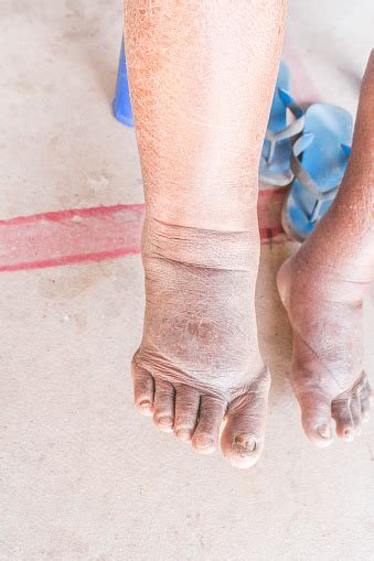 Foot Swelling On Diabetic Nephropathy Stock Photo Download Image Now