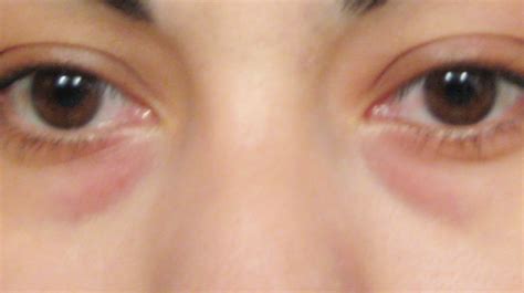 What To Do With Dark Circles Around The Eye In Good Health Buffalo