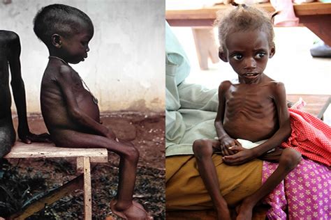 Kalori Malnutrisyonu Marasmus Ve Stres Açlığı Kwashiorkor Nedir