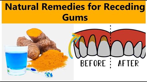 Natural Remedies For Receding Gums 2021 Youtube